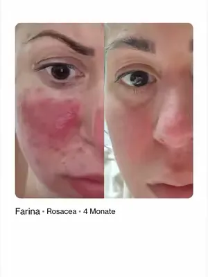 Rosacea muss kein Dauerzustand sein.  Dieses Vorher-Nachher von Farina zeigt, wie deutlich sich das Hautbild durch gezielte Behandlung und passende Pflege verbessern kann. Typische Symptome wie Rötung