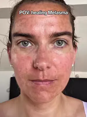 Natascha hat an Melasma gelitten, doch was ist das eigentlich?  Melasma ist eine stark pigmentierte, oft symmetrische Hautverfärbung, die meist im Gesicht auftritt: besonders an Stirn, Wangen, Oberlip