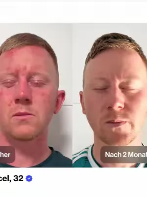 Wir stellen euch heute Marcel vor. Marcel litt unter Hautrötungen, Pusteln und Äderchen. Die Diagnose: Rosacea - ein wichtiger Schritt, denn Rosacea wird oft mit Akne verwechselt. ⠀ Typische Verstärke