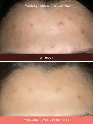 Now you see dark spots, now you don’t. The Mark’s targeted formula is Korean-engineered to fade visible marks fast—exactly where you need it.   No full-face treatments. No unnecessary irritation. Just