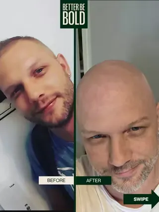 "Jahrelang habe ich mit meinen Haaren gekämpft. Nicht plötzlich, sondern schleichend. Mit Mitte 20 ging es los. Erst nur ein paar Haare mehr auf dem Kissen, dann immer mehr.  Der Haaransatz veränderte