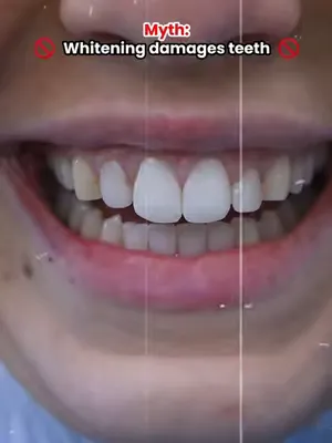 POV: You thought whitening damaged teeth… then you met Zenyum 😉✨